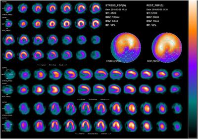 Case Series: Extracorporeal Shockwave Myocardial Revascularization Therapy Improves Ischemic Response, Functional Capacity, and Quality of Life in Indicated CABG-Stable Angina Pectoris Patients